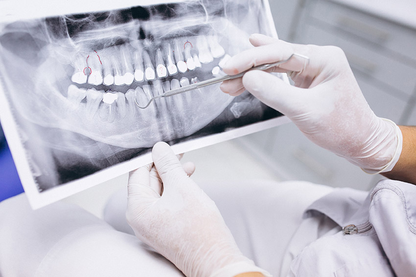 Ce presupune și cât costă o extracție dentară?